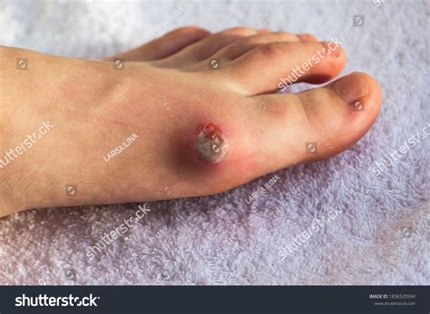Diabetes Mellitus Foot Infected Wound Treatment Stok Fotoğrafı