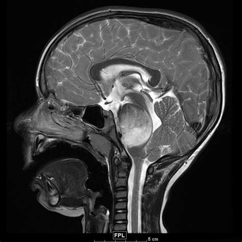 Retinal vascular tumors / nikolaos e. Dipg Brain Tumor 2019 - Brain Tumor Cancer