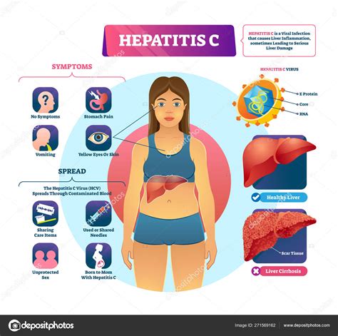 Ilustración del vector de la hepatitis C Esquema de explicación de infección viral etiquetada