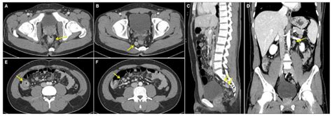 Abdominopelvic Computed Tomography Scan Indicating Multiple Enlarged