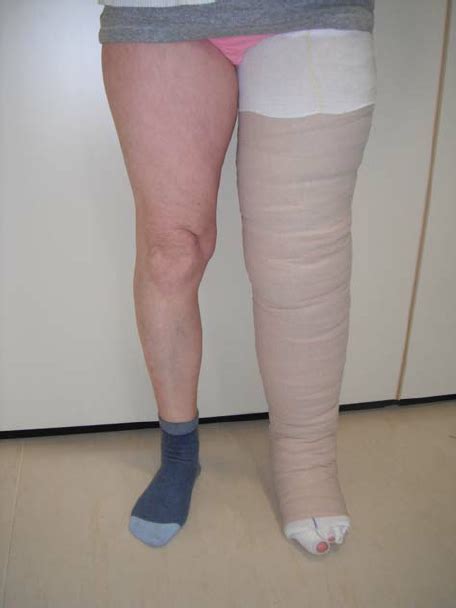Swollen Left Leg When The Patient Fi Rst Presented Download