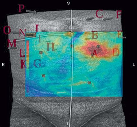 16 Indocyanine Greenspy Imaging In Perforator Flap Breast