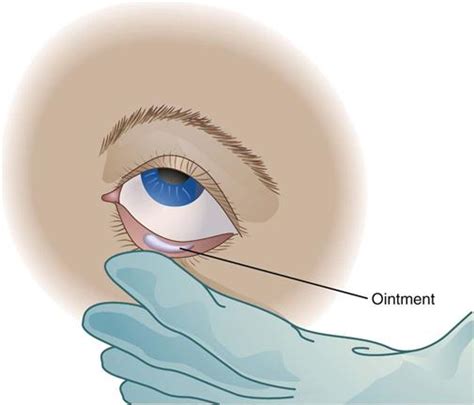 If the eye drop lands here, it is usually. Medication Administration | Nurse Key