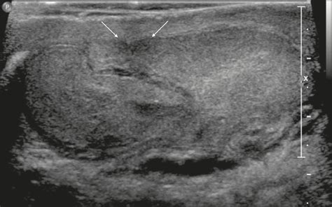 Scielo Brasil Ultrasound Evaluation Of Inguinoscrotal Pain An