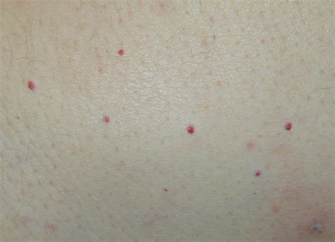 Skin Concerns Anyone Ever Have A Cherry Angioma Outbreak R