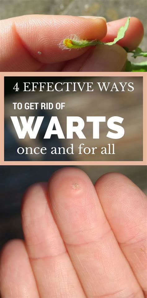 4 Effective Ways To Get Rid Of Warts Once And For All Get Rid Of Warts Warts Warts Remedy