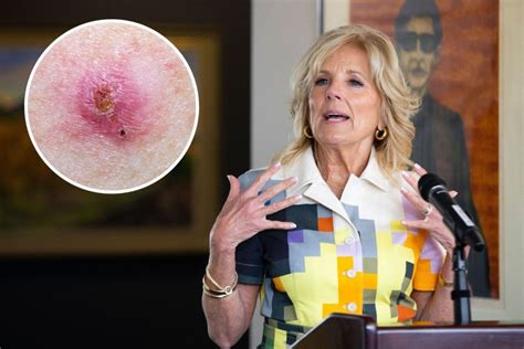 What Is Basal Cell Carcinoma Jill Biden Had Cancerous Lesions Removed