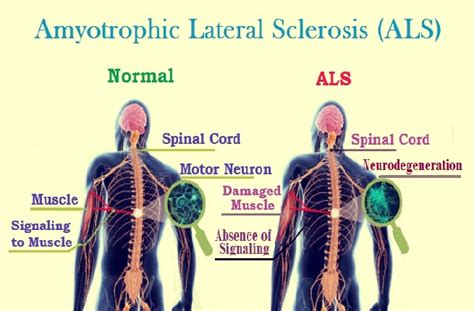 Amyotrophic Lateral Sclerosis Diagnosis And Treatment Care Tips For