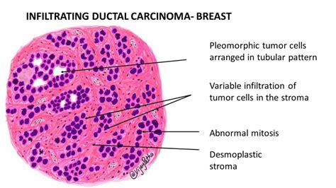 Pathology Of Infiltrating Duct Carcinoma Breast Pathology Made Simple