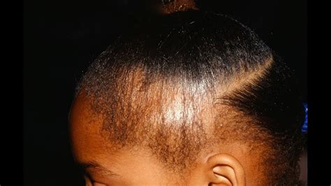 The hairline is one of the most sensitive areas of the head. Fixing Damaged Hair restoring edges - YouTube