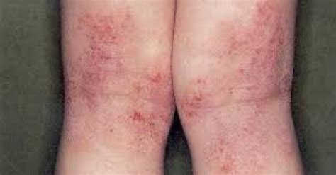 Qué es y cómo tratar la dermatitis atópica