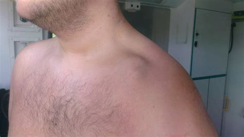 Broken Collar Bone Recovery Time Page 42 Pinkbike Forum