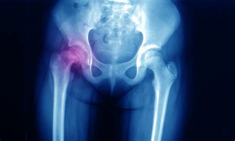 Total Hip Replacement How To Minimize The Risk Of Dislocation