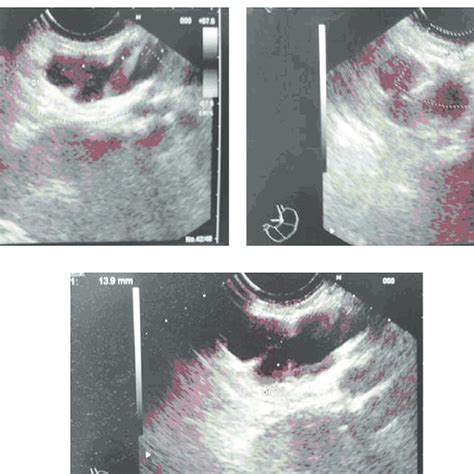 Oesophagogastroduodenoscopy Egd Cardias Without Mucosal Alterations