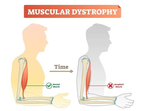 Different Types Of Myopathies Premier Neurology And Wellness Center