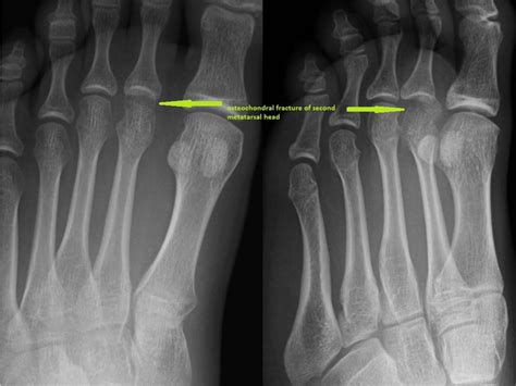 Unusual Osteochondral Fracture Of The Second Metatarsal Head In A Paediatric Patient Treated