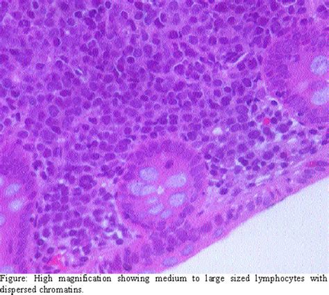 Extranodal Non Hodgkins Lymphoma In Hiv
