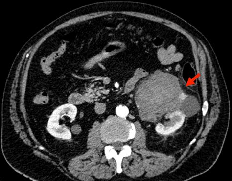 Cureus An Extremely Rare And Demanding Diagnosis Of Primary Renal Hot Sex Picture