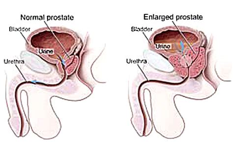 Enlarged Prostate Treatment May Be Simpler Than You Think