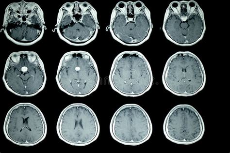 Mri Scan Of Patient Brain Stock Image Image Of Medical 115364225
