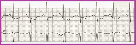 Float Nurse Practice Ekg Rhythm Strips 216