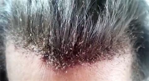 This Could Be The Most Extreme Head Lice Infestation And It Will Make