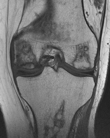 Osteochondritis Dissecans Of The Knee Radiology Reference Article