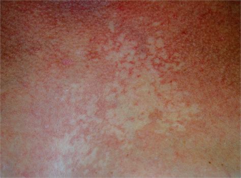 Nevus Anemicus And Bier Spots In Tuberous Sclerosis Complex Cutaneous