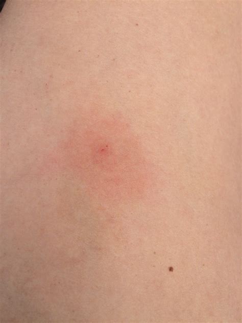 Round Red Spots On Legs Pictures Photos