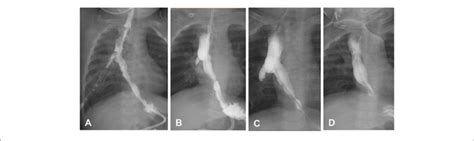 Changes In The Esophageal Diverticulum Ed Of Patient 3 A After