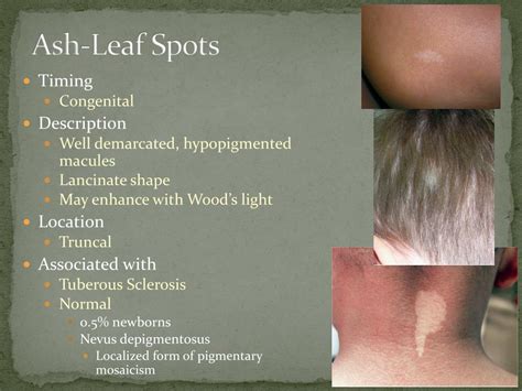 Ppt Disorders Of Pigmentation Powerpoint Presentation Id715908