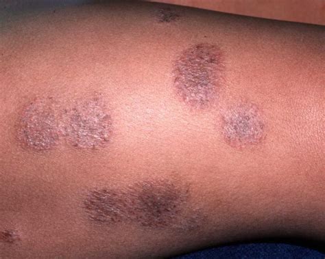 Psoriasis The Silent Skin Disease