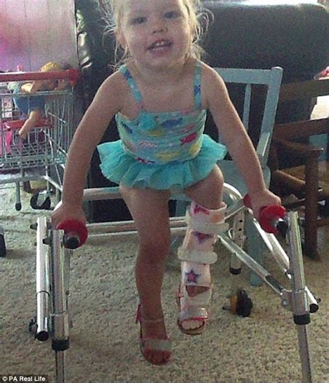 Mother Reveals Her Four Year Old Had To Have Her Leg Broken Three Times