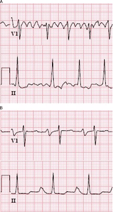 A Baseline Electrocardiogram Showing Coarse Atrial Fibrillation B