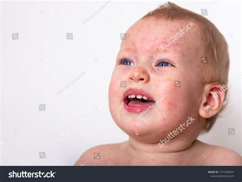 Crying Baby Has Face Allergy Roseola Stock Photo 1771900964 Shutterstock