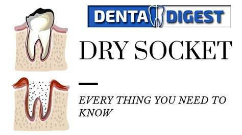 Dry Socket Everything You Need To Know Dentadigest