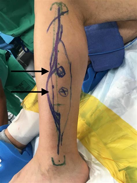 Cureus Chimeric Free Fibula Flap An Encounter With Aberrant Anatomy