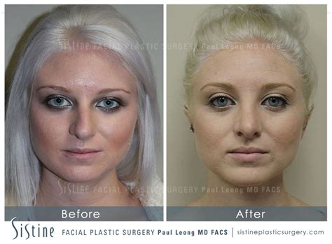 Non Surgical Rhinoplasty Before And After 18 Sistine Facial Plastic Surgery