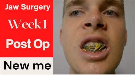 Corrective Jaw Surgery Experience Week 1 4 Youtube