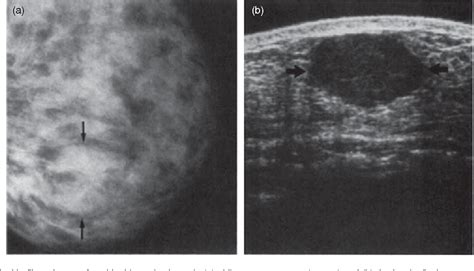 Pdf Ultrasound Diagnosis Of Breast Cancer Semantic Scholar