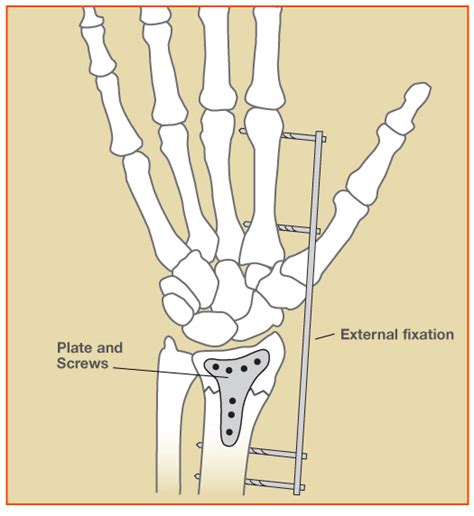 Distal Radius Wrist Fractures Orthopaedic Associates