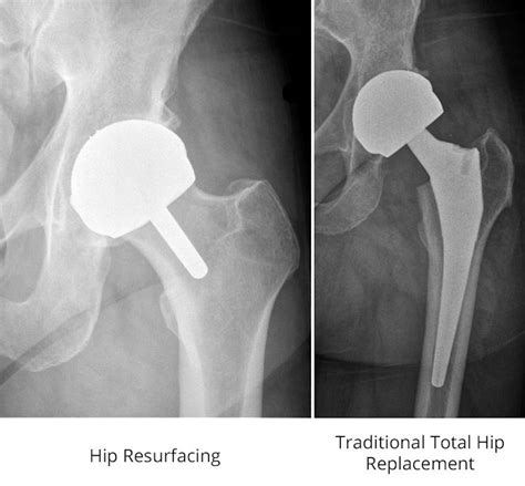 Hip To It What Runners Should Know About Hip Replacement Options Irunfar