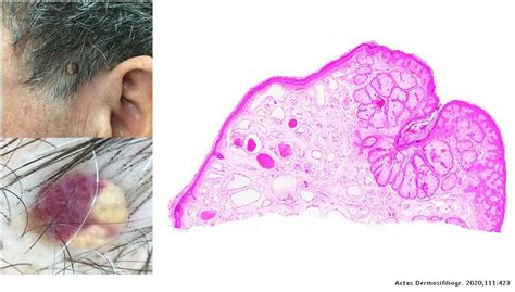 A Two Color Tumor Actas Dermo Sifiliográficas
