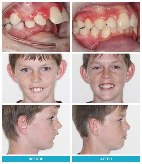 Maybe you would like to learn more about one of these? Before and After Photos | Greater Springfield Orthodontics