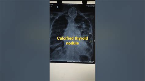 Calcified Nodule In Isthmus Of Thyroid Gland Youtube