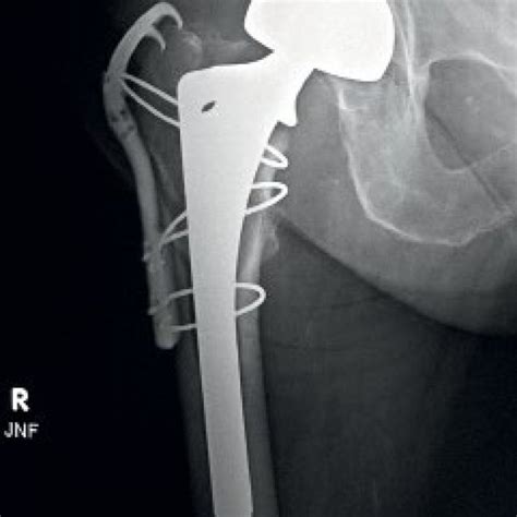 Pdf Intraoperative Periprosthetic Femoral Fractures At Total Hip
