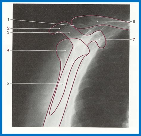 Lateral Scapula Radiography Radiography Radiology Imaging Radiology