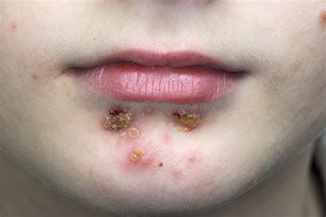 Fda How To Treat Impetigo And Control This Common Skin Infection