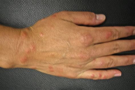 swimmers itch picture - pictures, photos