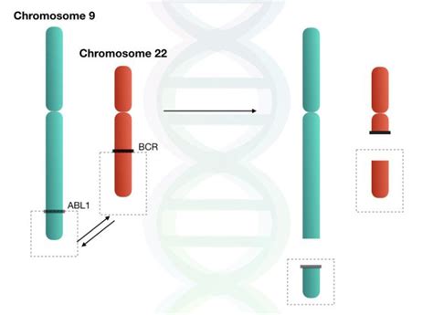 Philadelphia Chromosome Bcr Abl1 Gene Fusion And Chronic Myeloid Leukemia Genetic Education